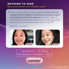 Real results, real progress photos — all thanks to their consistent 2x  daily intake of Lactoferrin + d-Alpha Tocopheryl Acetate + Zinc  (Lactezin).​ ​ Try now to help treat and prevent pimples