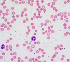 En la esclerosis múltiple, la histología o estudio de los tejidos del sistema nervioso reveló que hay un proceso de inflamación que daña la capa de mielina pueden compararse tratamientos en función de la histología de la esclerosis múltiple, diseñando planes terapéuticos con aquellos que han. Enfermedad Autoinmunitaria Wikipedia La Enciclopedia Libre