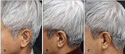 The issues of laser hair removal don't just deal with your skin, but your body as a whole. The Cure For Grey Hair Hair Loss Cure 2020