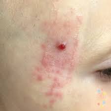 Image result for Pyogenic Granuloma