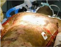 Dark patches of dead skin on the wound surface can be alarming to an individual who is recuperating from a burn wound or a diabetic ulcer, but this tissue, also known as eschar, is a normal part of the healing process. Emergency Escharotomy Protocopedia