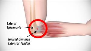 Many people have visited physical therapists and doctors to no avail. Tennis Elbow Assessment Youtube