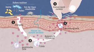 Neurodermitis Symptome Schnell Erkennen Focus Arztsuche