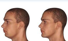 We did not find results for: 7 Mewing Before And After Ideas Jawline Mew Jaw Exercises