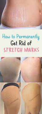 How To Permanently Get Rid Of Stretch Marks Stretch Marks Stretch Mark Remedies Beauty Tips Home Remedy