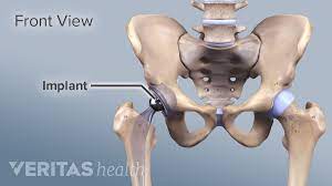 You may believe that hip replacement is the only way to: Indications And Eligibility For Total Hip Replacement Surgery