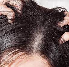 The harsh chemicals in hair dyes can wreak havoc on your scalp, leaving it dry and flaky. How To Get Rid Of Dandruff With Natural Ingredients Bullfrag