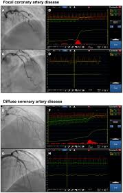 Image result for TMC FFR