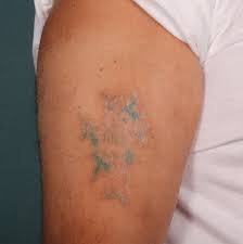 We did not find results for: Laser Tattoo Removal Eden Laser Clinics