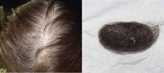 During treatment for hair loss, you can expect to return to the doctor periodically to determine the hair loss doesn't only happen to men. Hair Loss In The Elderly Springerlink
