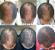 Regrow Hair Products