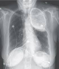 Why One Woman Had Oil In Her Lung For Decades Lunges Oils Cooking Oil