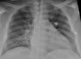 Large Clinical Trial In Africa Tests Treatments For Mild And Moderate Covid 19 Cases Global Biodefense