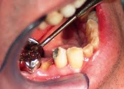 Image result for Alveolitis sicca)