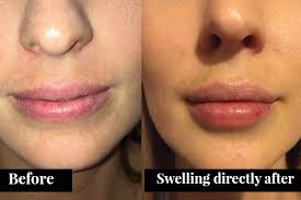 Rabach says that depends on how much a patient gets, their metabolism, the desired plumpness, and the product used, but you can usually expect anywhere from. 7 Things You Always Wanted To Know About Lip Fillers