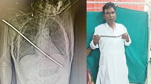 Kgmu Doctors Saved Life Of A Critical Patient In Lucknow. - Amar Ujala  Hindi News Live - दिल के आर-पार हो गई थी सरिया:डॉक्टरों ने बचा ली जान,  दावा- इस तरह के