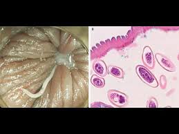 Cacing kremi hidup dalam usus besar manusia. Enterobius Vermicularis Youtube