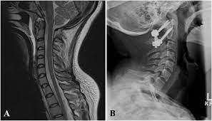 Closed Reduction Of Traumatic Atlantoaxial Rotatory Subluxation With Type Ii Odontoid Fracture Sciencedirect