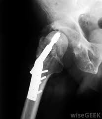 Did this article help you? What Is Pelvic Bone Cancer With Pictures