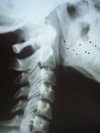 Más concretamente, los pacientes con rectificación cervical presentan un desequilibrio causado por la debilidad en los músculos extensores . Rectificacion Cervical Dolores Musculares Cervicales Mareo Vertigo Acufenos Zumbidos Tratamiento Argentina