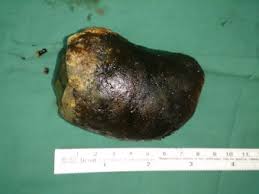 We have come to a conclusion that some territories of the russian federation. Single Giant Gallstone Measuring 95mm 60mm 45mm Download Scientific Diagram
