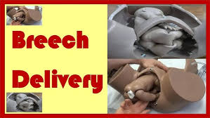 Image result for Breech Delivery