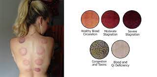 Effective ways to get rid of hickeys. Cupping City Acupuncture Circle