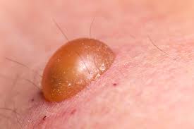 Image result for syphilis symptoms