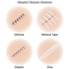 When you need them, stitches are important because they: Care For Your Stitches Aftercare Instructions What You Need To Know