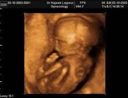 شكل الجنين الولد في السونار في الشهر الرابع الساعة 25