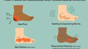 A plantar fibroma can develop in one or both feet, is benign (nonmalignant) and usually will not go away or get smaller without treatment. Pain In The Feet As A Symptom Of Rheumatoid Arthritis