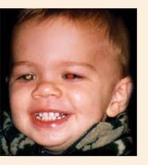 Dealing with childhood cancer is something no parent should have to go through. Retinoblastoma
