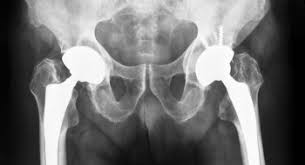 Maybe you would like to learn more about one of these? Cementless Hip Implants Are Gradually Losing Their Popularity In Europe Covering The Specialized Field Of Orthopedic Product Development And Manufacturing