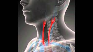 Check spelling or type a new query. Symptoms Of Blocked Arteries In Neck Youtube
