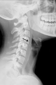If you notice the second tooth from the left, you can see a dark aura surrounding the tip of the root. Foreign Bodies On Lateral Neck Radiographs In Adults Imaging Findings And Common Pitfalls Radiographics