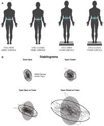 Image result for Romberg Test