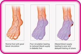 Do You Suffer From Poor Circulation Here Is How To Solve Your Problem In Just 20 Minutes Poor Circulation Circulation Problems Bad Circulation