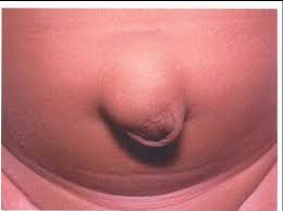 تكيف الملفوف الصيني لا يتحرك اسباب الفتاق عند الرجال dsvdedommel com