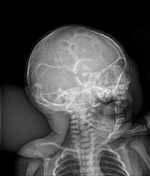 Can the net harness a bunch of volunteers to help bring books in the public domain to life through podcasting? Copper Beaten Skull Radiology Reference Article Radiopaedia Org