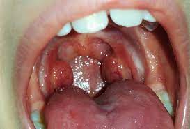 Copilul are rosu in gat? Spitalul Virtual Pentru Copii Ieri Am Avut Cursul SÄptÄmanal Cu RezidenÈii Pe Care Ii Indrum In Cadrul FormÄrii Lor Ca Pneumologi De Copii Si Am Vorbit Despre InfecÈiile De Sezon Cu
