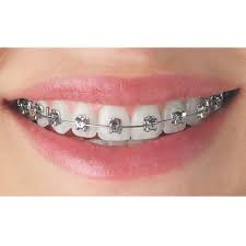 Kamu pasti gak percaya diri kan saat berada dikeramaian, tapi. Damon Braces Braces Self Ligating Audy Dental
