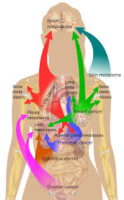 Metastasis (the spread of cancer throughout the body) is a major cause of death in connection with colon cancer. Department Of Surgery Liver Metastases