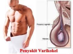 Mengobati Varikokel Secara Alami Dengan Cara Herbal Tanpa Operasi Herbal Yang Dimaksud Adalah Obat Penyakit Varikokel Ace Maxs Yang Penyakit Herbal Operasi