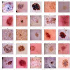 It may grow slowly and it's typically treatable. Deep Learning For Diagnosis Of Skin Images With Fastai By Aldo Von Wangenheim Towards Data Science