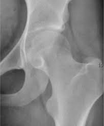 Image result for Hip XRay