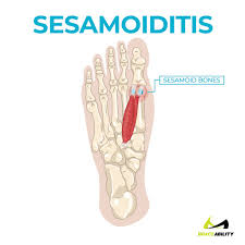 I have noticed that many people use side of foot pain as their search term. Ball Of Foot Pain Do The Bottoms Of Your Feet Toes Hurt
