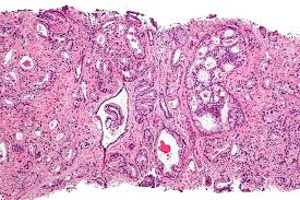 What causes prostate cancer is uncertain, but there are known risk factors, such as age or inherited genetic when prostate cancer is caught early, treatments can cure the disease. Scientists Identify Why Some Prostate Cancers Are More Likely To Result In Death Phillyvoice