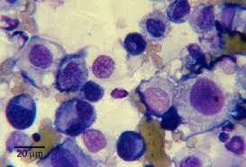 Maybe you would like to learn more about one of these? Palliative Intracavitary Carboplatin Therapy In A Cat With Suspected Pleural Mesothelioma Sciencedirect
