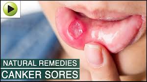 Canker Sores Natural Ayurvedic Home Remedies Youtube