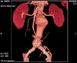 El término aneurisma proviene del vocablo griego anéyrysma y significa dilatación. Aneurisma Aortico Abdominal Prevencion Y Diagnostico
